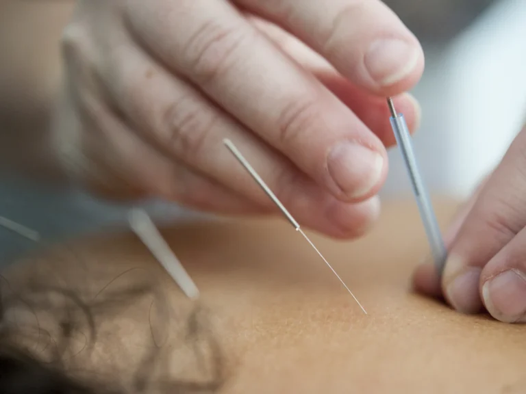 Acupuncture needles inserted into skin