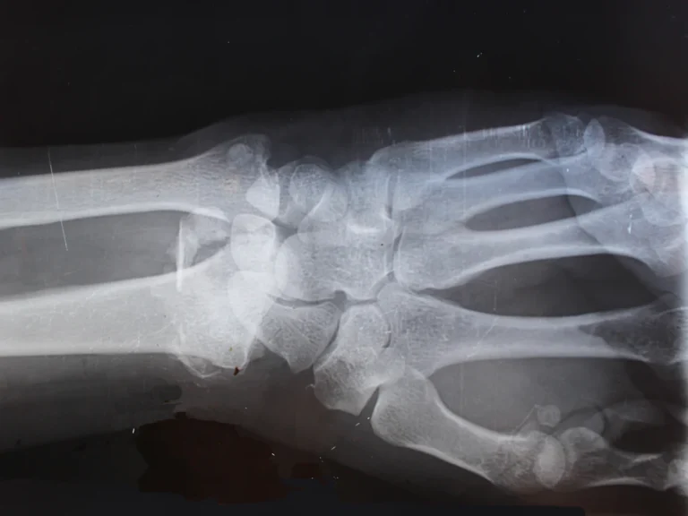 X-ray result